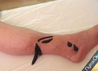 Blutegel-Therapie / Pióca terápia